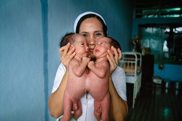 War legacy: Twins born Siamese because of indirect Agent Orange exposure. Photo © Catherine Karnow.